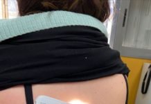 Dermatoscopios para los centros de salud de atención primaria dermatoscopios