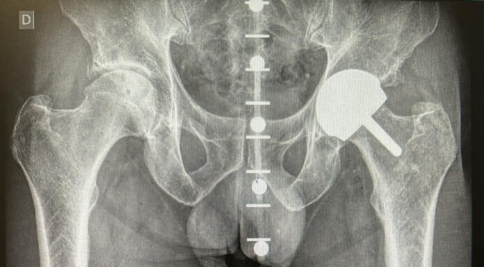 La prótesis de cadera se coloca más precisa con un software 3D prótesis de cadera